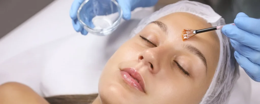 athena-chemical-peel