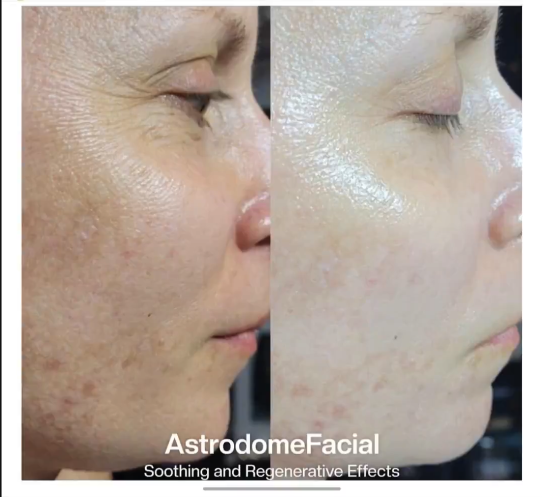 Hydrafacial – näyttökuva