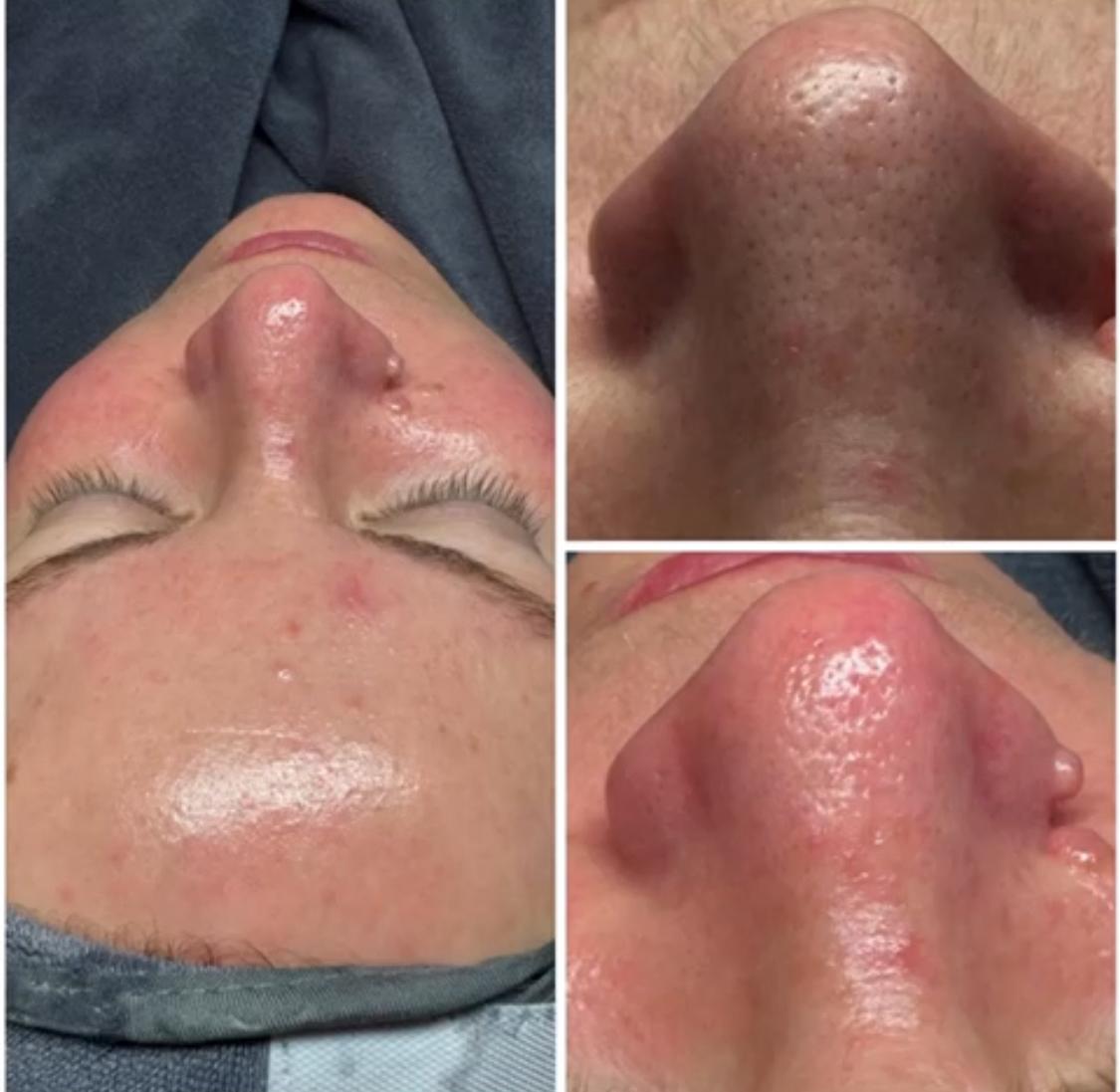 Hydrafacial – klinikalta kuva