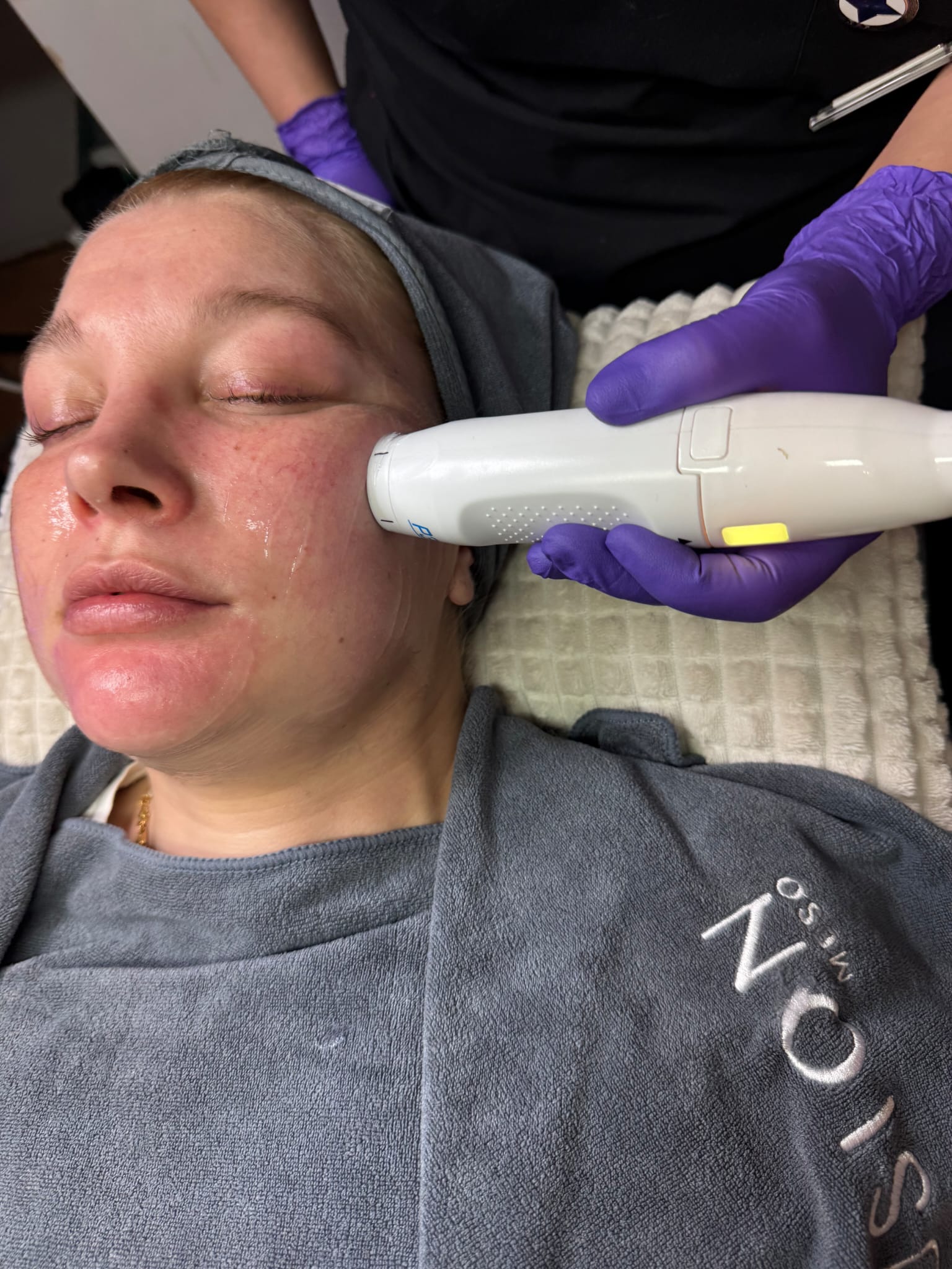 HIFU – tuloskuva 1