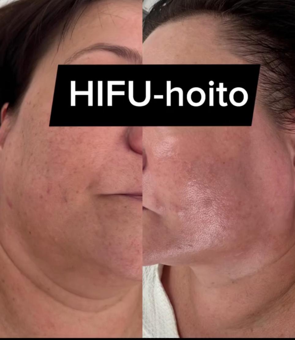 HIFU – результат, изображение 1