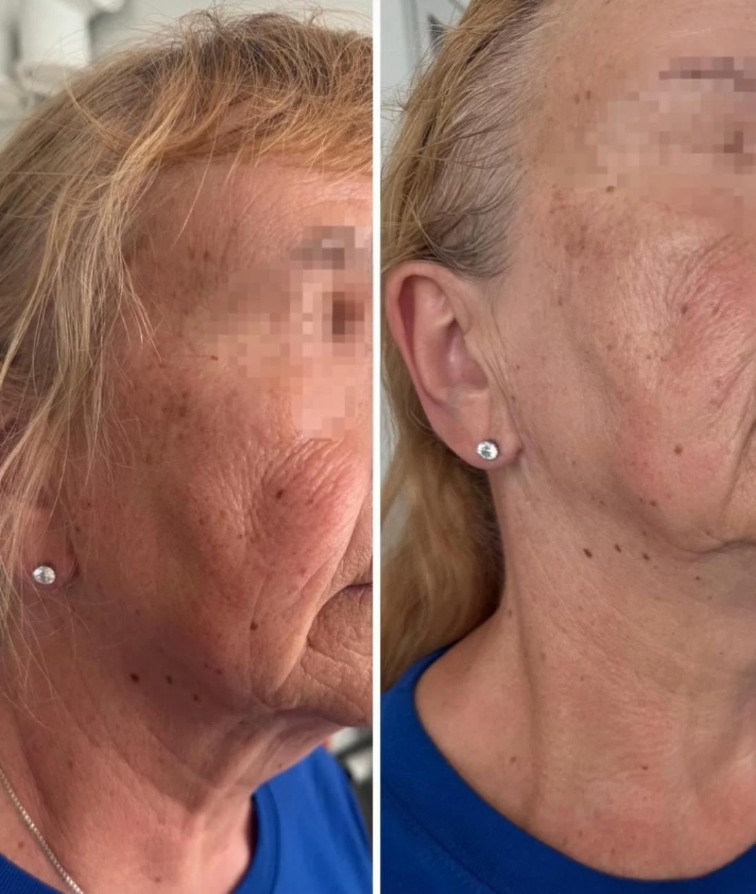 HIFU – результат, изображение 1