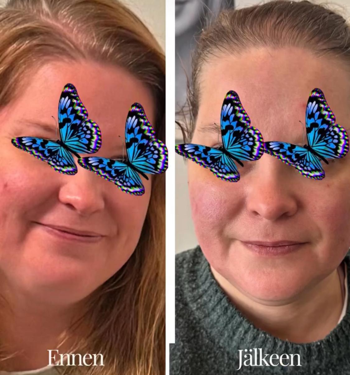 HIFU – результат, изображение 1