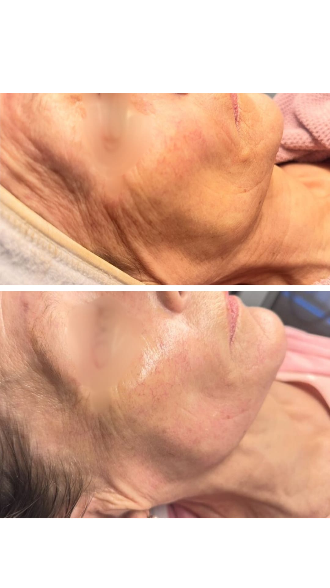 HIFU – результат, изображение 1