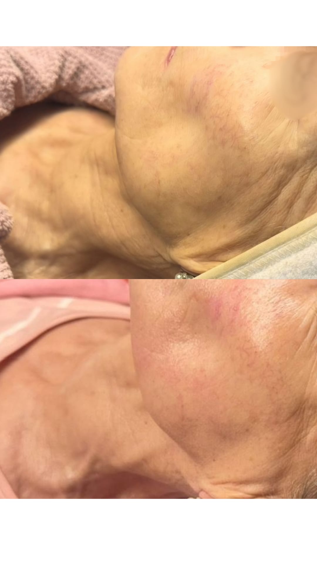 HIFU – результат, изображение 1