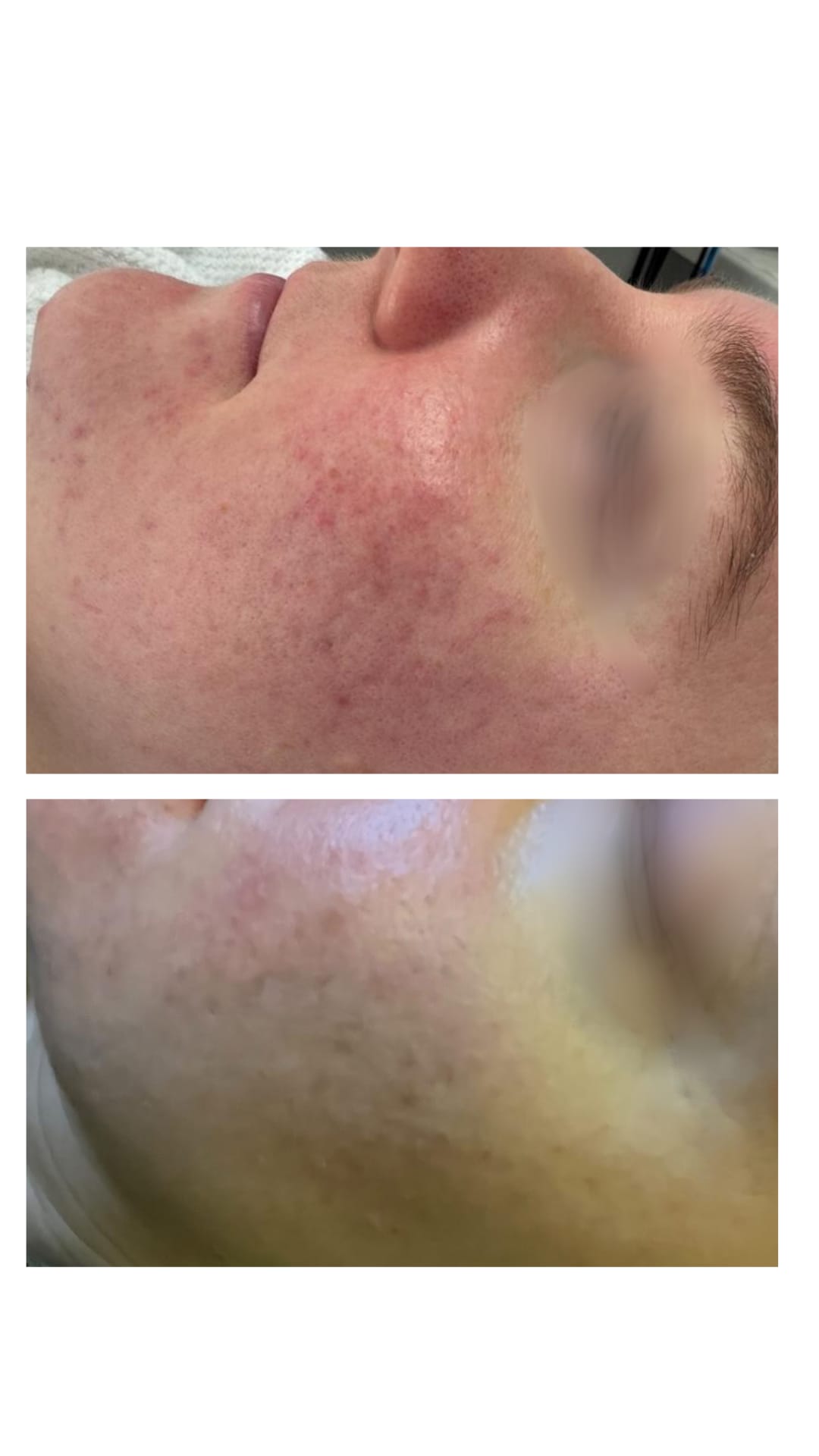 BBL Light – ennen–jälkeen