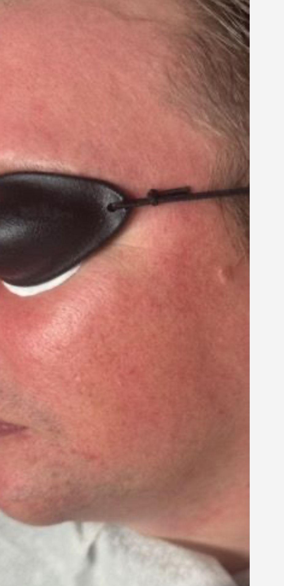 BBL Light – ennen–jälkeen