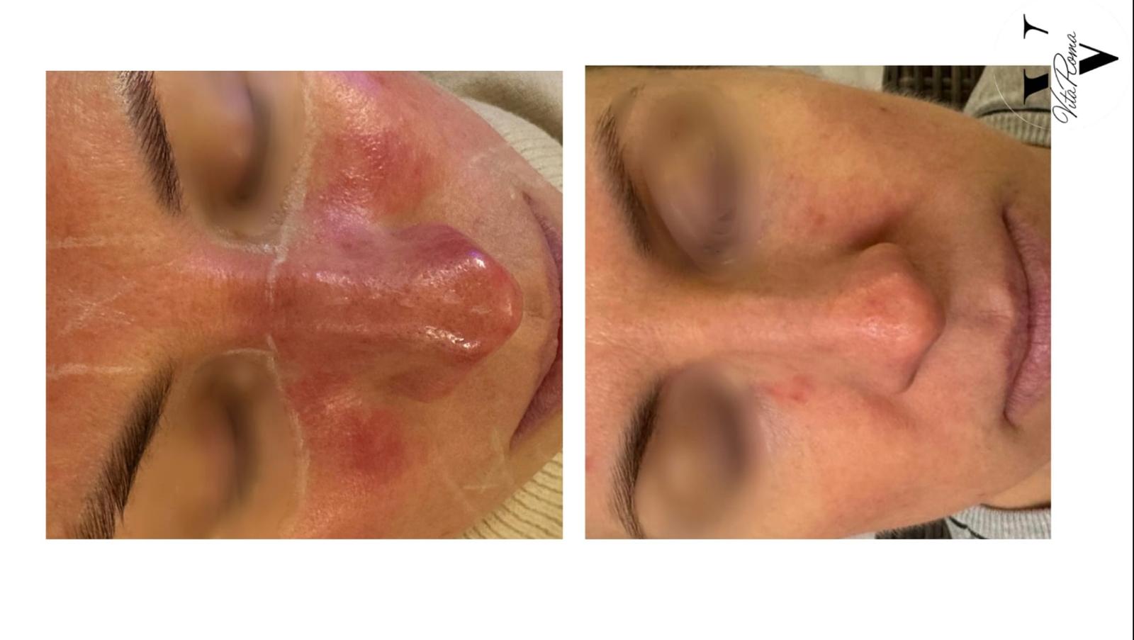 BBL Light – ennen–jälkeen