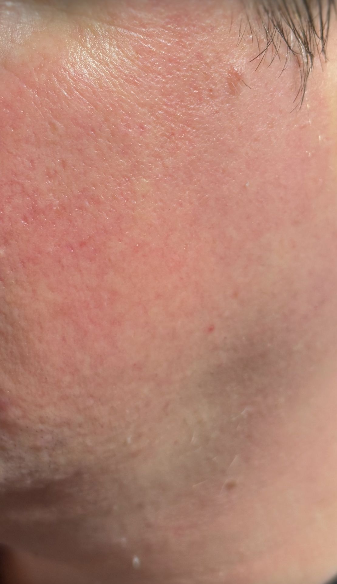 BBL Light – ennen–jälkeen